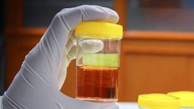 Ini Ciri Ciri Urine yang Mengindikasi Kerusakan Ginjal